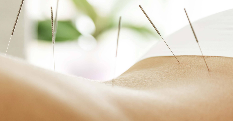 Zapraszamy na kurs SUCHE IGŁOWANIE (Dry needling) w ujęciu klinicznym w 2 modułach