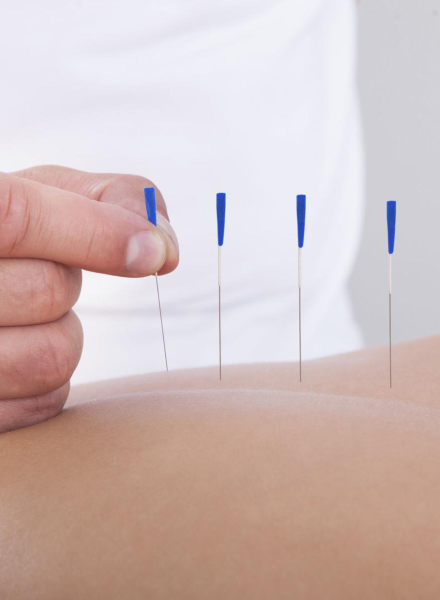 Kurs SUCHE IGŁOWANIE (Dry needling) w ujęciu klinicznym Moduł II